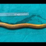 2-Foot Eel Up Man’s Rectum Eats Through His Intestines