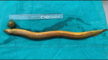 2-Foot Eel Up Man’s Rectum Eats Through His Intestines