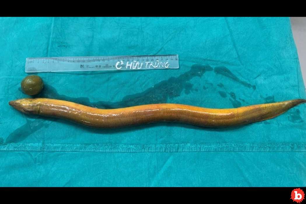 2-Foot Eel Up Man’s Rectum Eats Through His Intestines