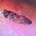 Indian Man’s Upset Stomach Caused By a Live Cockroach In His Belly