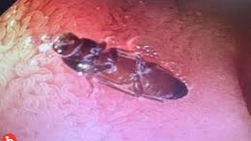 Indian Man’s Upset Stomach Caused By a Live Cockroach In His Belly