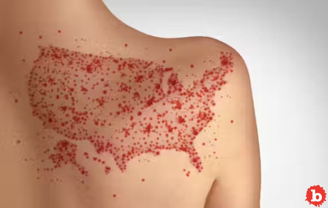 CDC Tries to Hide Report That Says Measles Vaccine Works